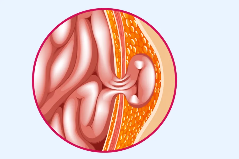 Diagnóstico y tratamiento integral de hernias en Tijuana