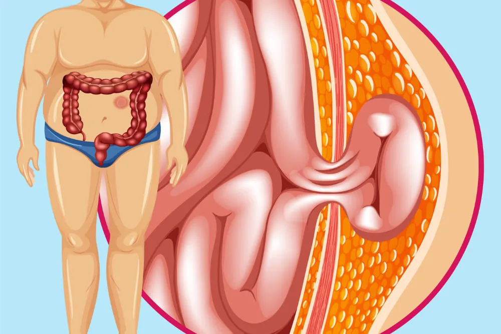 Manejo de hernias en pacientes con obesidad en Tijuana