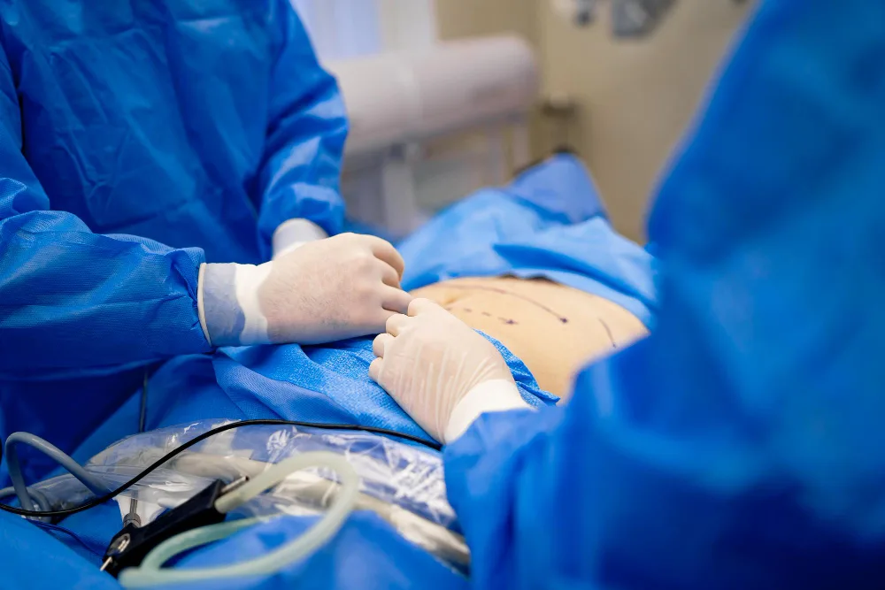 Reparación de hernia postincisional