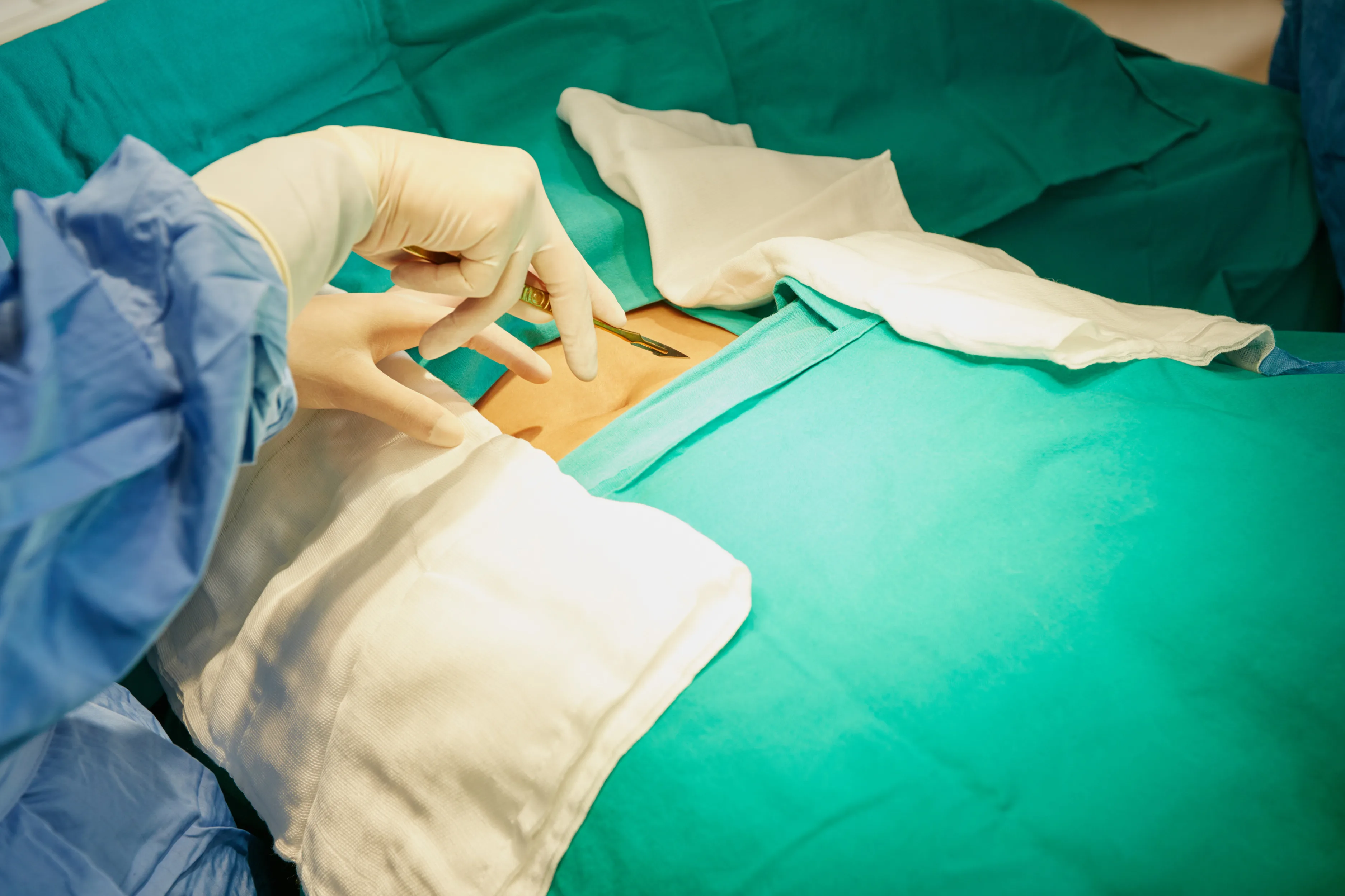 Reparación de hernias gigantes, recidivantes o complejas